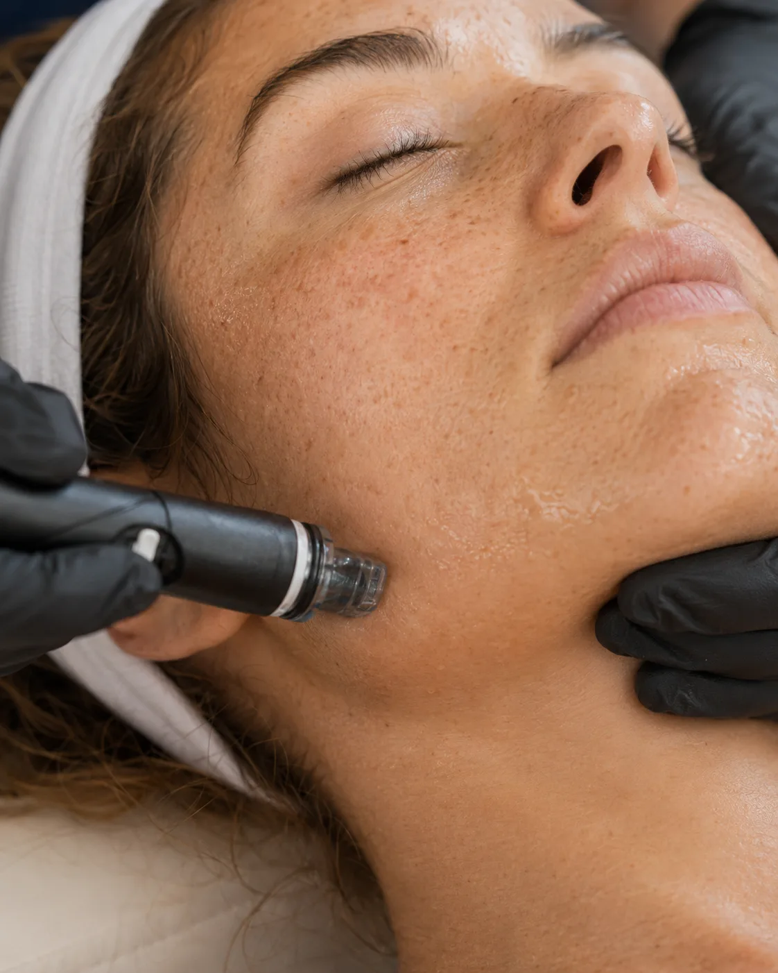 Peeling kératolytique sur zone T