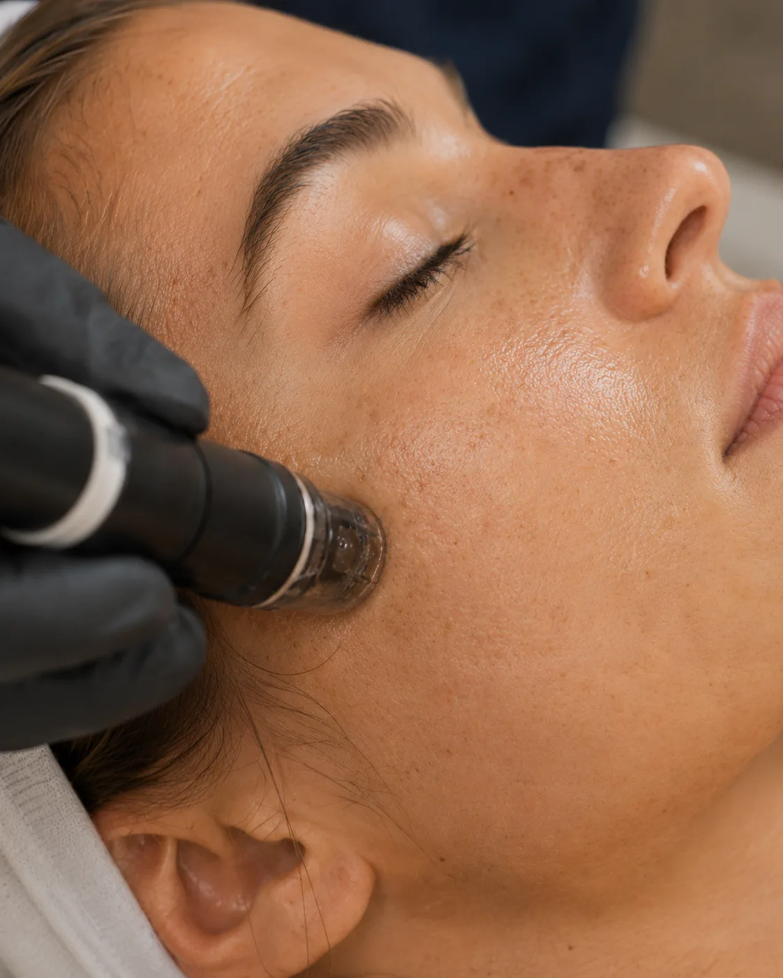 Peeling dermatologique — préparation du visage